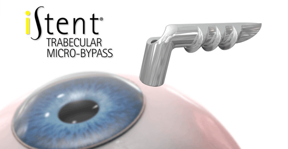 iStent trabecular micro-bypass