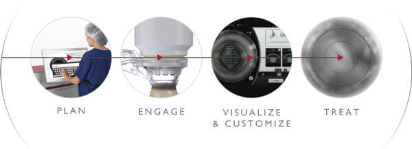 laser cataract surgery